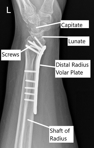 Post-operative x-ray of the wrist in lateral view.