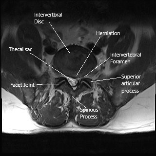 MRI axial section of the lumbar spine showing foraminal stenosis.