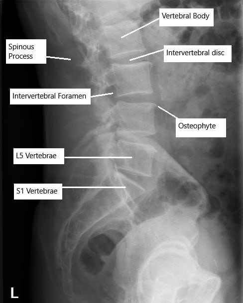 X-ray of the lumbar spine showing degenerative changes.