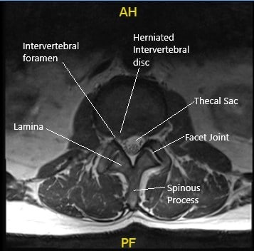 Preoperative Axial MRI section at the L2-L3 level showing herniated disc.