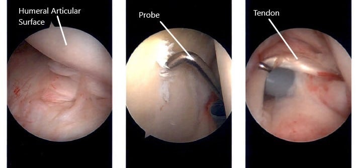 Intraoperative arthroscopic images of the left shoulder.