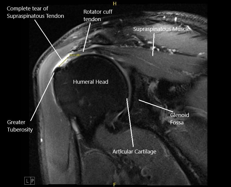 MRI image of the left shoulder showing a complete tear of the rotator cuff.