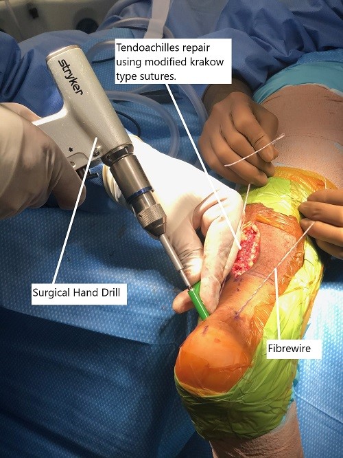 Intraoperative image showing the Tendon Achilles repair. Intraoperative image showing the Tendon Achilles repair.