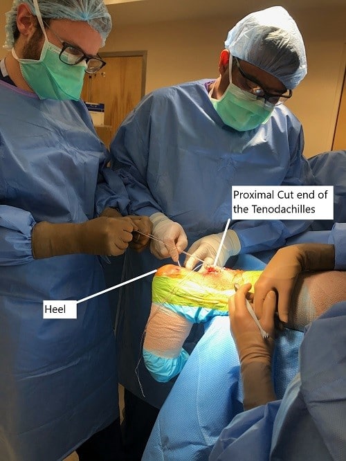 Intraoperative picture of the Tendoachilles repair. Intraoperative picture of the Tendoachilles repair.