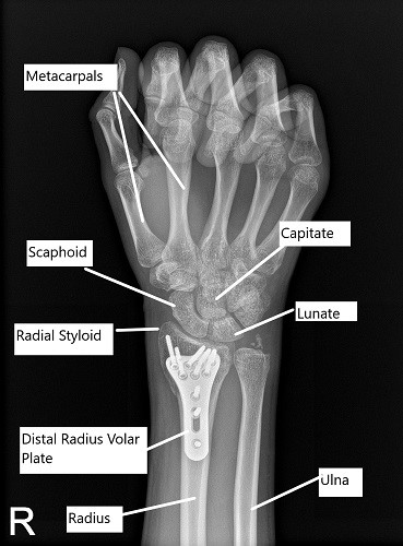Post-operative x-ray of the right wrist in PA view.