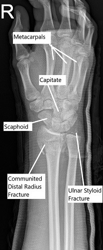 X-ray of the wrist in oblique view showing a comminuted fracture of the distal radius.