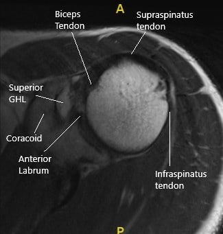 MRI of the left shoulder in axial section.