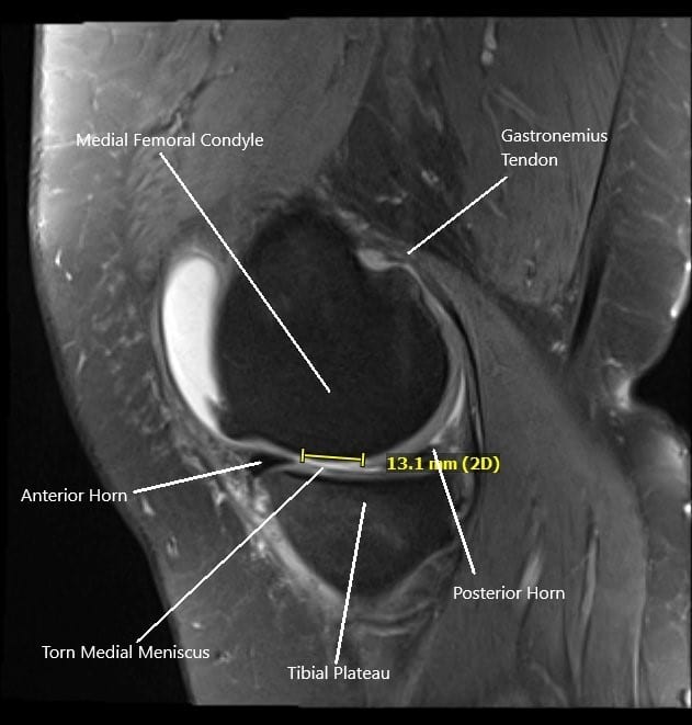 MRI of the right knee in sagittal section showing tear of the medial meniscus.