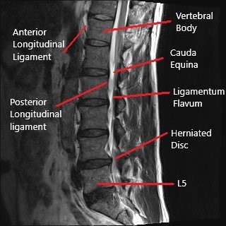 MRI of the lumbar spine in the sagittal section showing L4-L5 disc herniation.