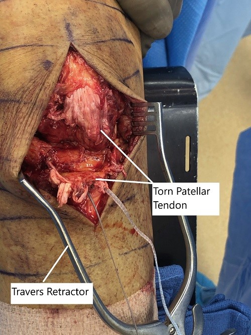 Intraoperative image showing the torn patellar tendon.
