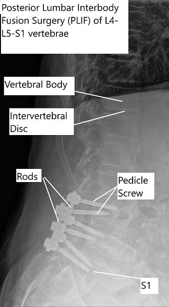 X-ray of the lumbar spine showing PLIF surgery.