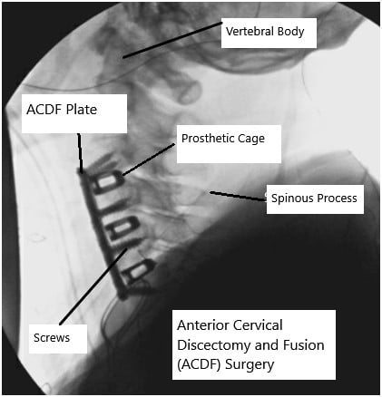 X-ray showing ACDF surgery.