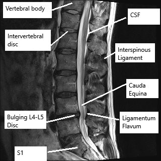 MRI of the lumbar spine in the sagittal section.