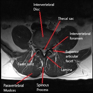MRI of the lumbar spine in the axial section.