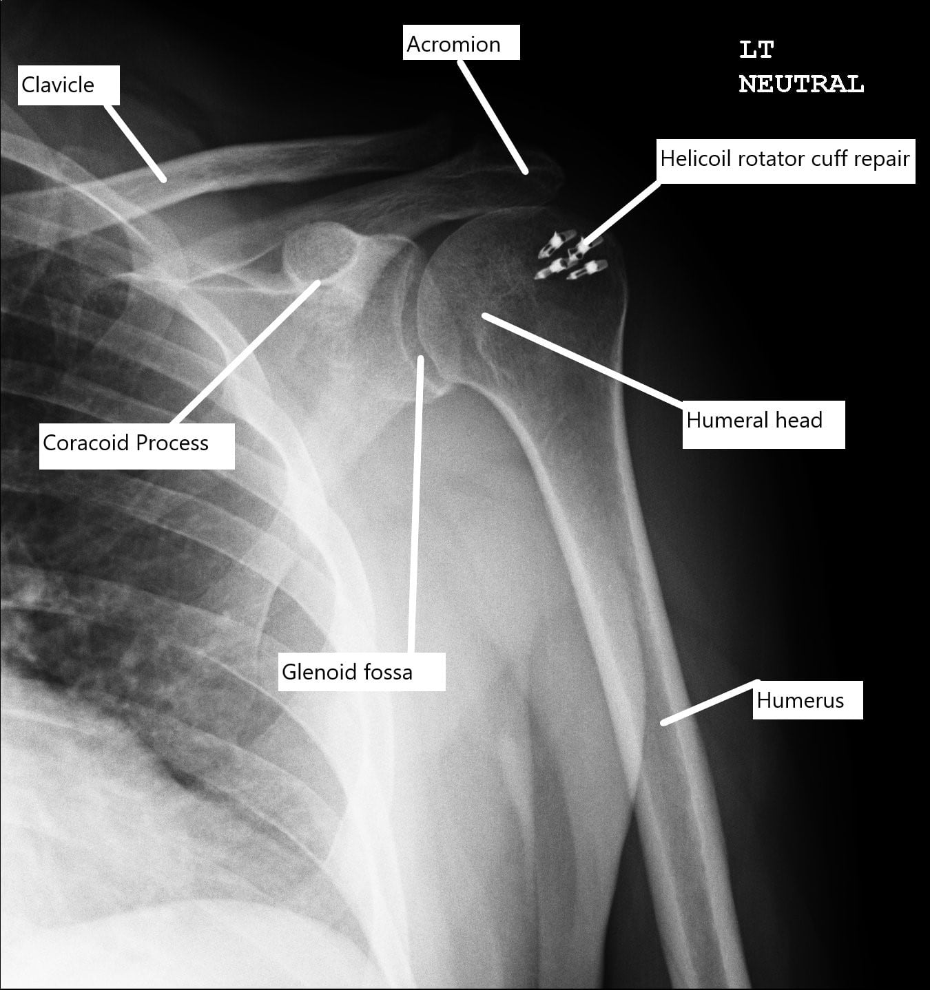 Postoperative X-ray of the shoulder with rotator cuff repair.