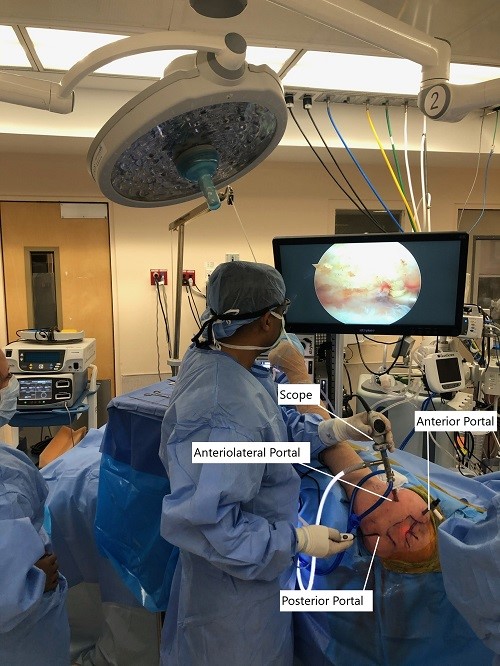 Intraoperative picture of arthroscopic shoulder surgery set up.