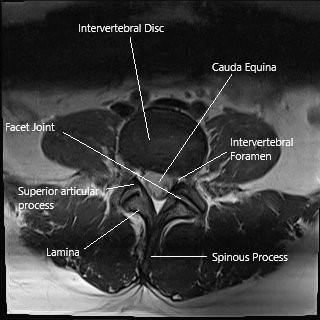 MRI of the lumbar spine in axial section.