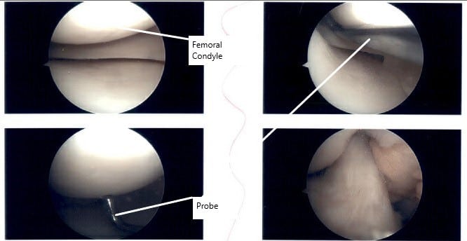 Intraoperative right knee arthroscopic images.