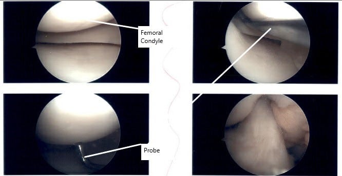 Imágenes artroscópicas intraoperatorias de la rodilla derecha.