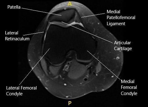 MRI of the right knee in axial section.