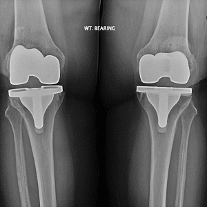 joint-replacement-xray
