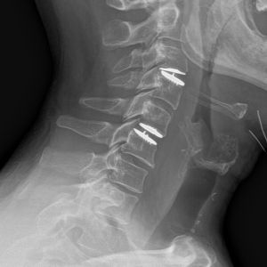 radiografía de la columna vertebral