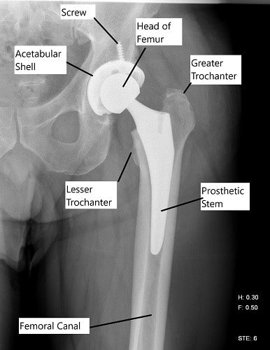 X-ray showing a total hip replacement.