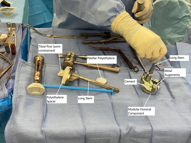 Intraoperative image showing modular knee replacement implants. Intraoperative image showing modular knee replacement implants.