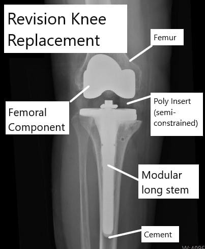 Revision knee replacement showing use of semi-constrained components.