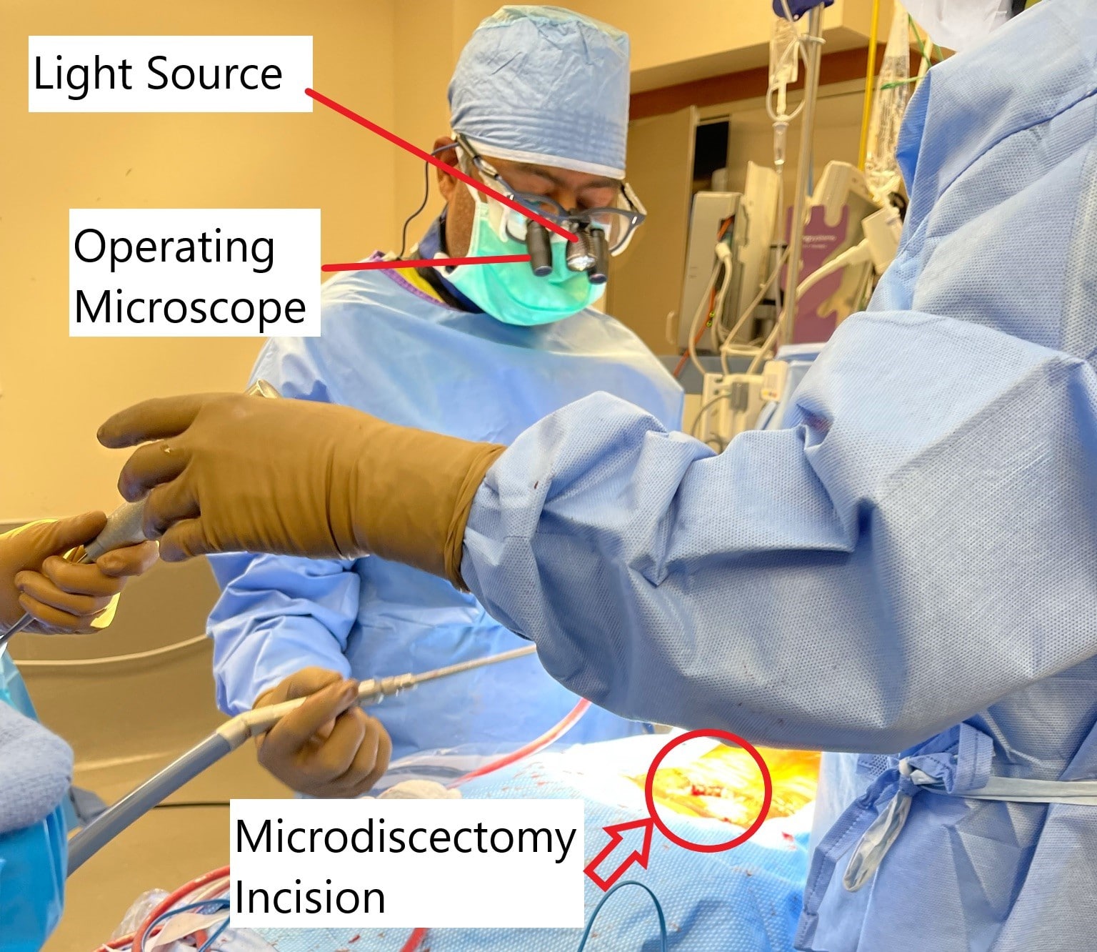 Intraoperative image showing microdiscectomy surgery.