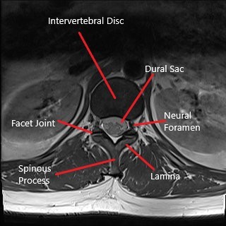 Axial section of lumbar spine MRI.