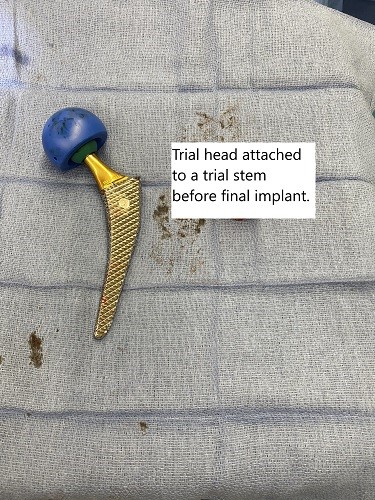 Intraoperative image of total hip replacement.