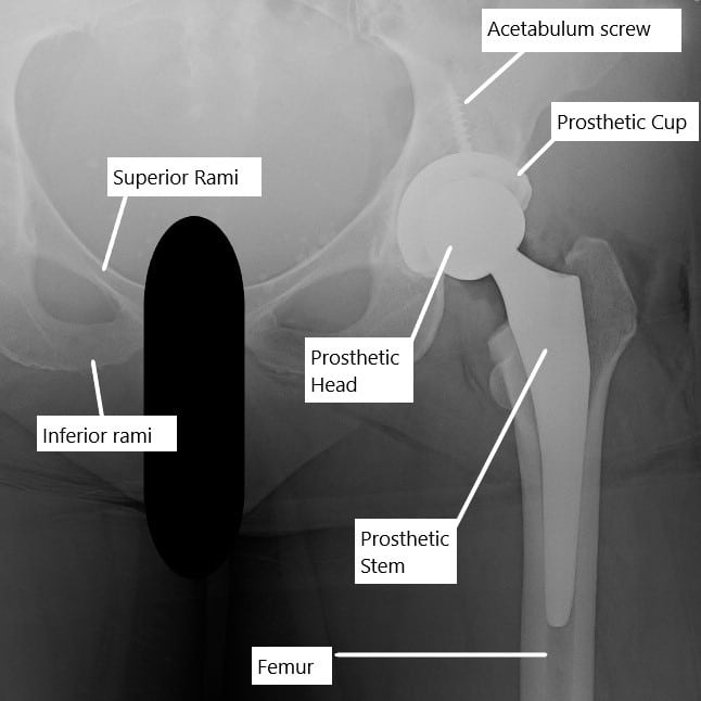 X-ray showing a total hip replacement.