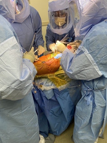 Intraoperative image showing closure of a total knee replacement.