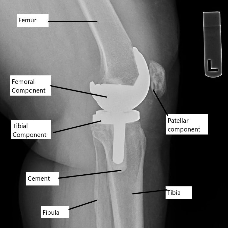 pain after knee replacement