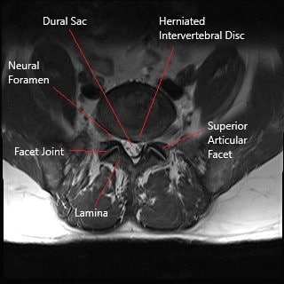 Axial section section of lumbar spine showing herniated intervertebral disc.
