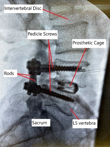 X-ray showing lumbar spine fusion at L4-L5 level.