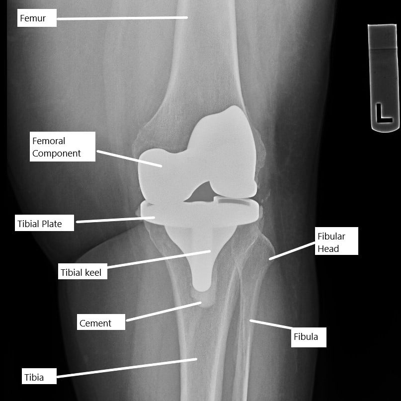 X-ray showing a total knee replacement.