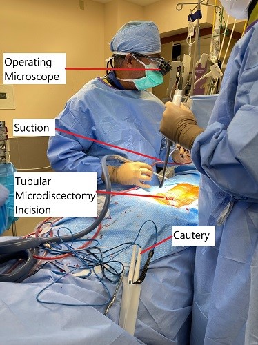 Imagen intraoperatoria que muestra microdiscectomía tubular. Imagen intraoperatoria que muestra microdiscectomía tubular.