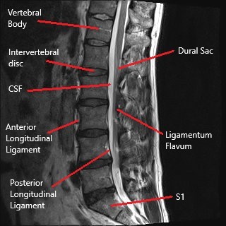 Sagittal section of the lumbar MRI.