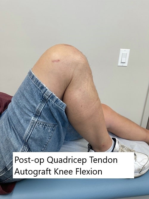 Postoperative images showing quadriceps tendon autograft scar and range of motion.