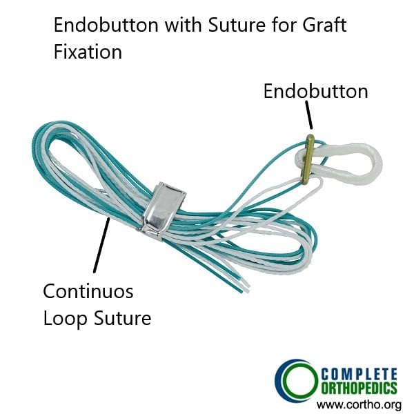 Endobutton used to secure the ACL graft.