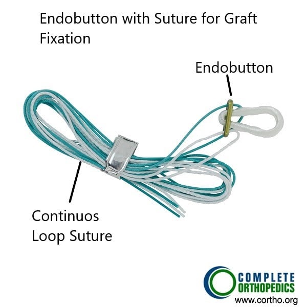 Endobutton used to secure the ACL graft. Endobutton used to secure the ACL graft.