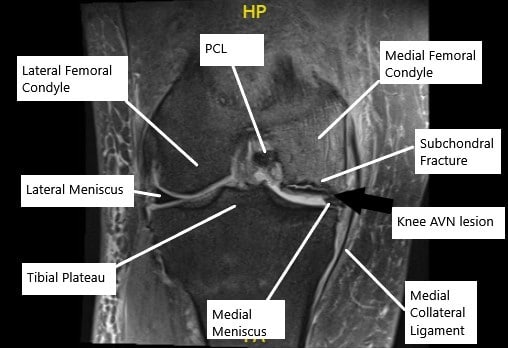 MRI of the knee in the coronal section showing AVN lesion along with subchondral fracture in the medial femoral condyle.