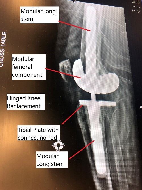 Intraoperative fluoroscopic image showing modular revision knee replacement.