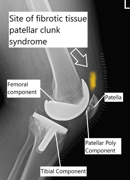 X-ray showing total knee replacement and the site of fibrous tissue in patellar clunk syndrome.