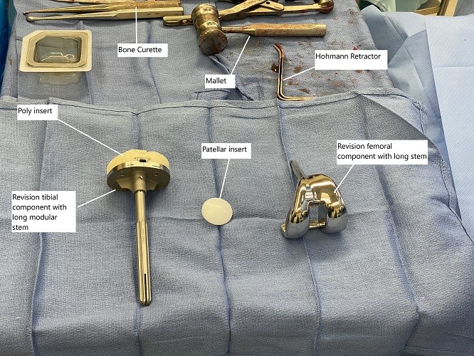 Intraoperative implants and instruments used in revision knee surgery.