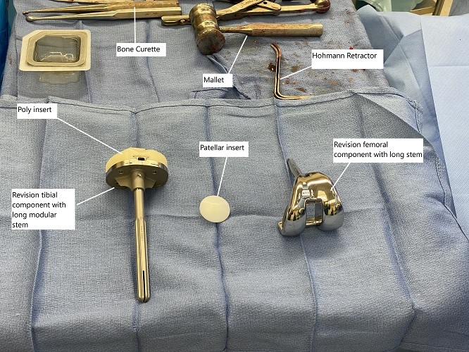 Intraoperative implants and instruments used in revision knee surgery. Intraoperative implants and instruments used in revision knee surgery.