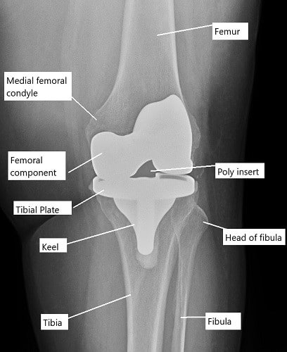 X-ray showing total knee replacement.