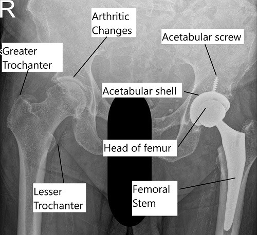 X-ray showing a total hip replacement surgery.